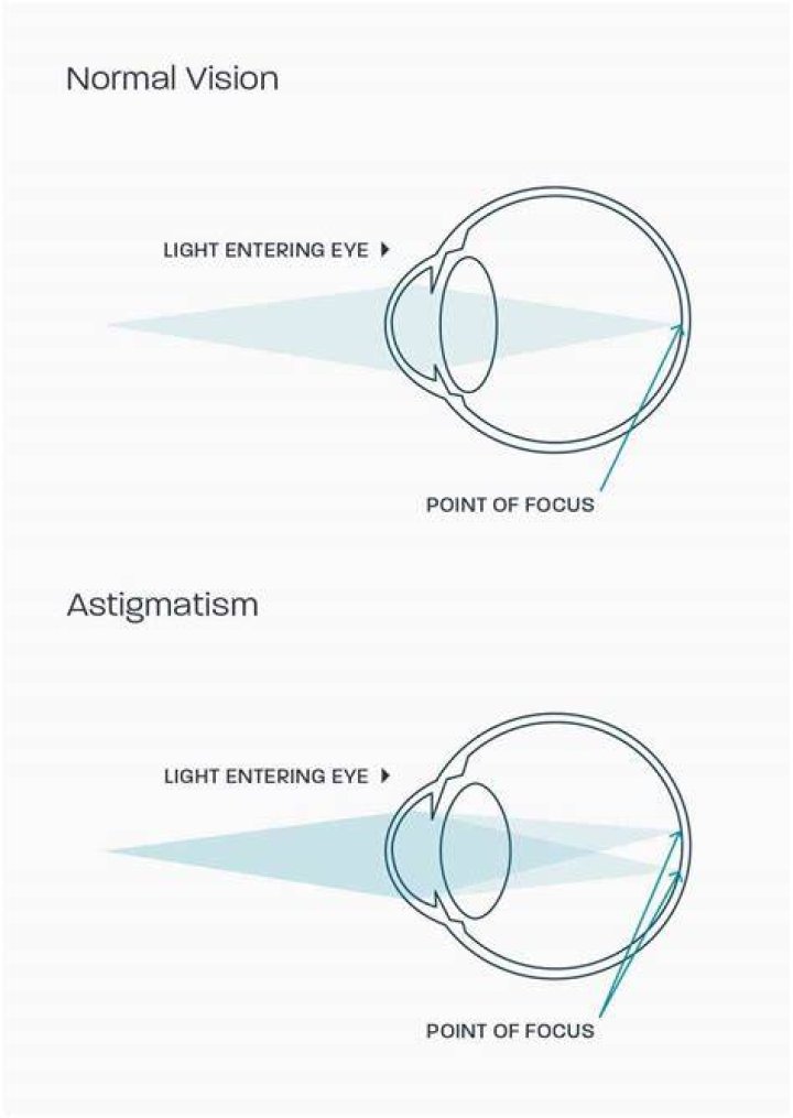 A Complete Guide to Astigmatism Symptoms, Causes, Diagnosis, and