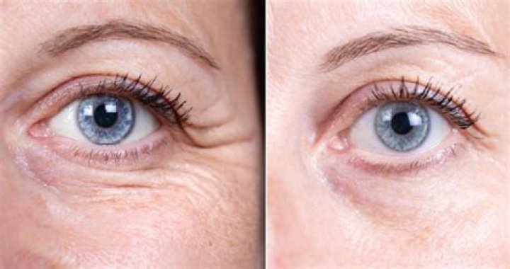 Achieve Youthful Radiance with Jelly Roll Botox Botox Brow Lift