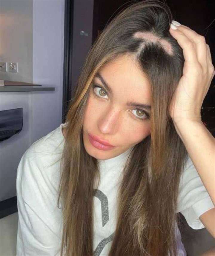 Aleska G&eacute;nesis tiene alopecia por qu&eacute; se le est&aacute; cayendo el pelo a la