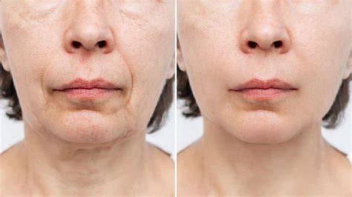 Before and After Facetite Photo Gallery Brent Moelleken M.D.