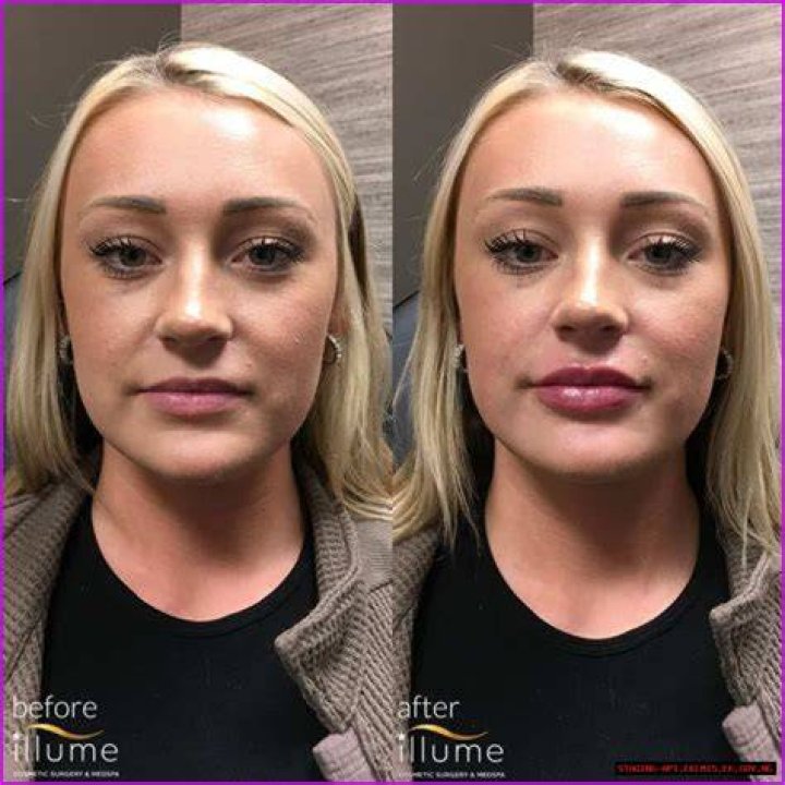 Beth Dutton Lip Injections Surgery Before And After Photos