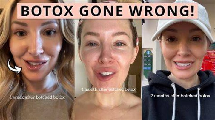 Botox Injection gone wrong on Cheryl Hinds for 'Suburgatory