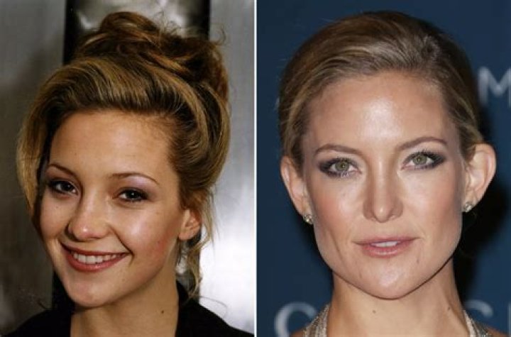 Celebrity Nose Jobs Before & After Irish Mirror Online