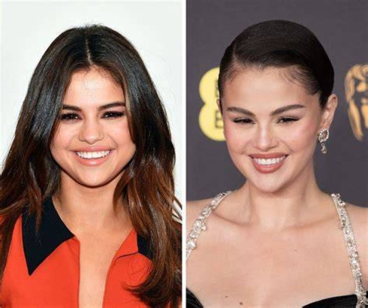 Did Selena Gomez Actually Get Plastic Surgery?