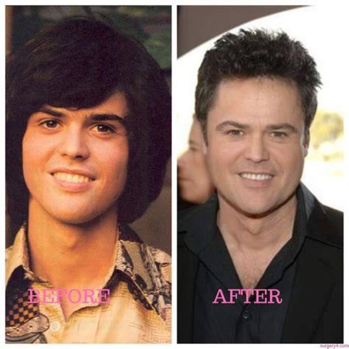 Donny Osmond Plastic Surgery Is Know All About the Osmonds&rsquo; Brother