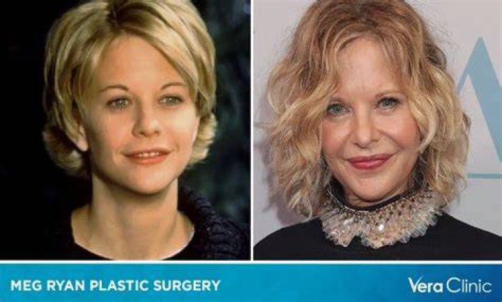 Meg Ryan Plastic Surgery Before and After Pictures 2021