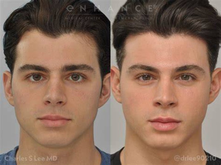Pierre Boo Plastic Surgery [REVEALED] FitGAG