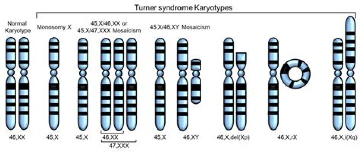 Turner Syndrome Q & A (2nd Edition) YouTube