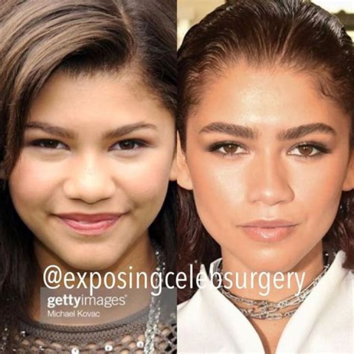 Zendaya plastic surgery 2014 before and after pictures